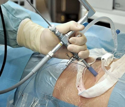 Kidney Stone Treatment